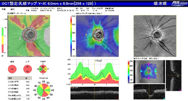 眼底三次元画像解析装置（OCT）検査